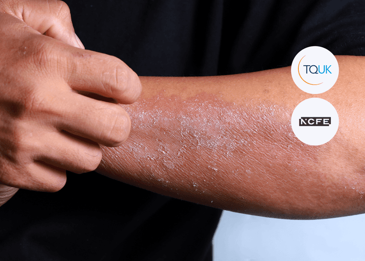 Close-up of a person scratching an irritated, inflamed patch of skin on their arm, symbolising allergic reactions, with TQUK and NCFE logos.
