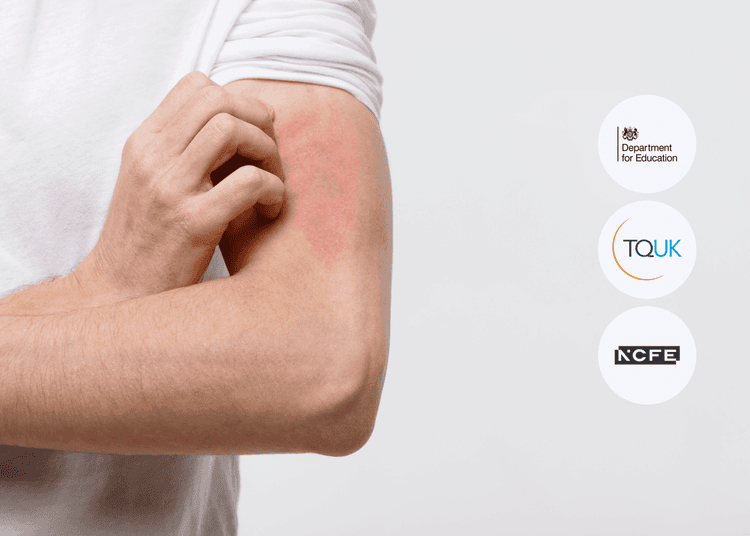 A visible allergic skin reaction, highlighting the importance of allergy awareness in roles in the service sector. Close-up of a service worker scratching a red, irritated rash on their upper arm - caused by an allergic reaction.